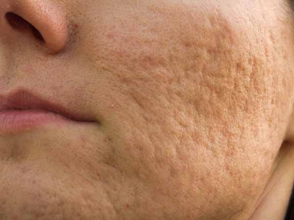 Cicatrices de acné:  soluciones dermatológicas en Guatemala