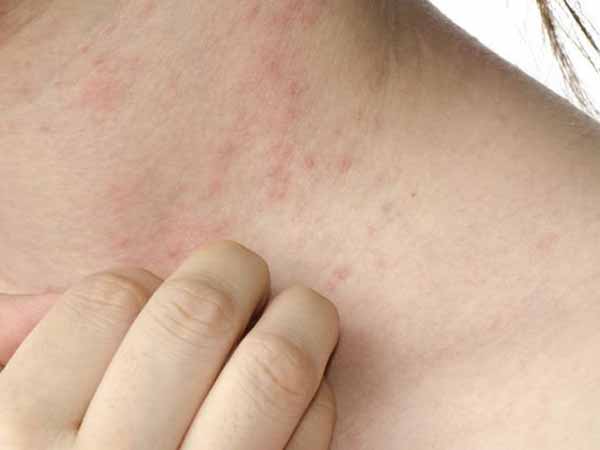 Alergias y dermatitis de contacto