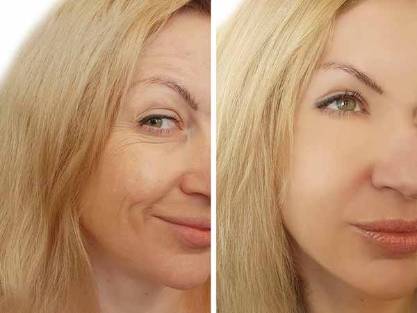 Tratamiento dermatológico: arrugas