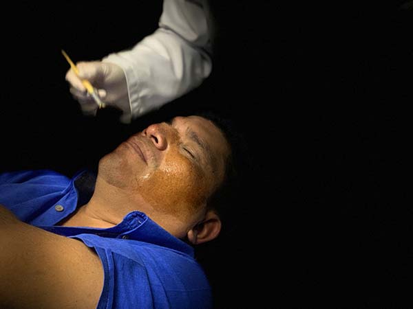 Tratamiento de Efelide y lentigos en Dermatología Guatemala